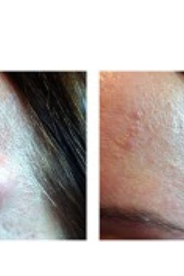 Inkspired - Signs You Need Lipoma Removal Now