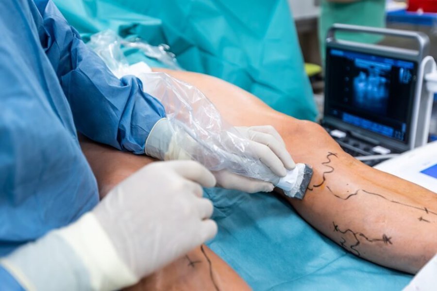 Best Varicose Veins Treatment in Pune – Dr. Lalit Banswal, Laser Specialist