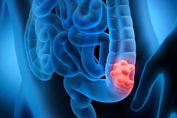Best Colon Cancer Surgeon in Hyderabad - Dr. MSS Keerthi