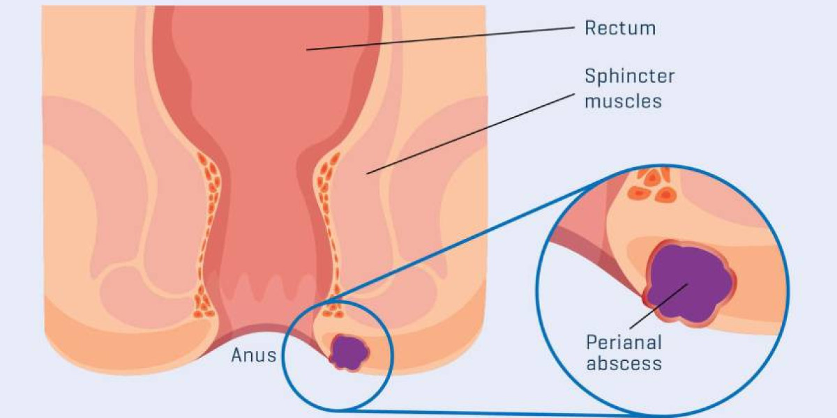 Perianal Abscess – Stage 1 & Stage 2 Surgery