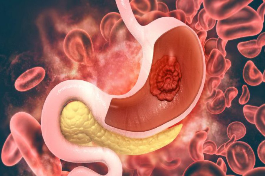 Best GI Cancer Treatment in Pune | Dr. Lalit Banswal – Expert Surgical Oncologist