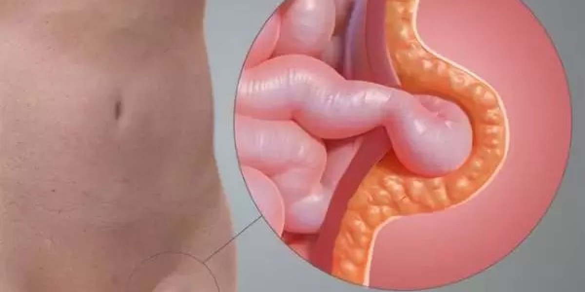 Femoral Hernia Treatment in Pune
