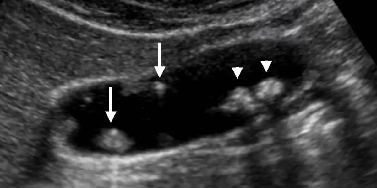 Gallbladder Polyps Treatment in Pune | Kaizen Gastro Care