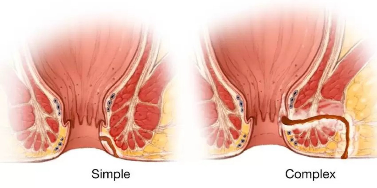 Simple vs. Complex Fistulas: Why the Classification Matters for Treatment
