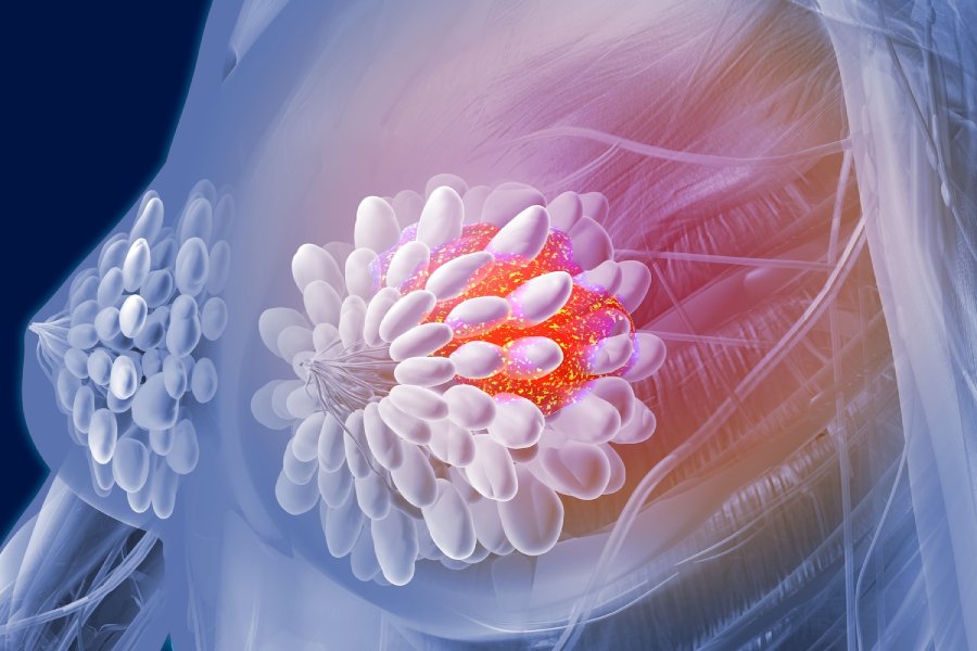 Dr. Lalit Banswal | Visit Best Breast Cancer Specialist in Pune