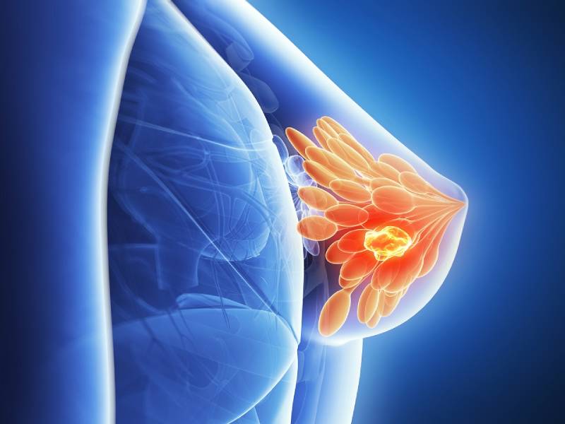 Breast Cancer Specialist in Pune | Breast Cancer Surgeon: Dr. Manoj Dongare